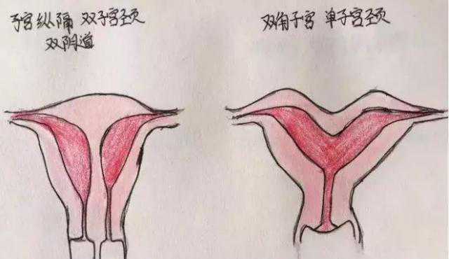 杭州医院供卵费用，子宫畸形，都长啥样？一起来看下