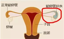 杭州正规代怀公司，杭州做第三代试管婴儿要花费多少钱？